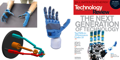 Upper Limb Prosthetics